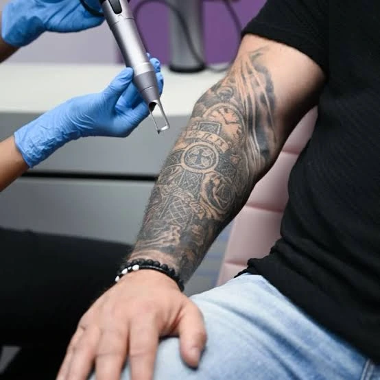 Discover Targeted Skin Solutions with Laser Tattoo Removal Abu Dhabi
