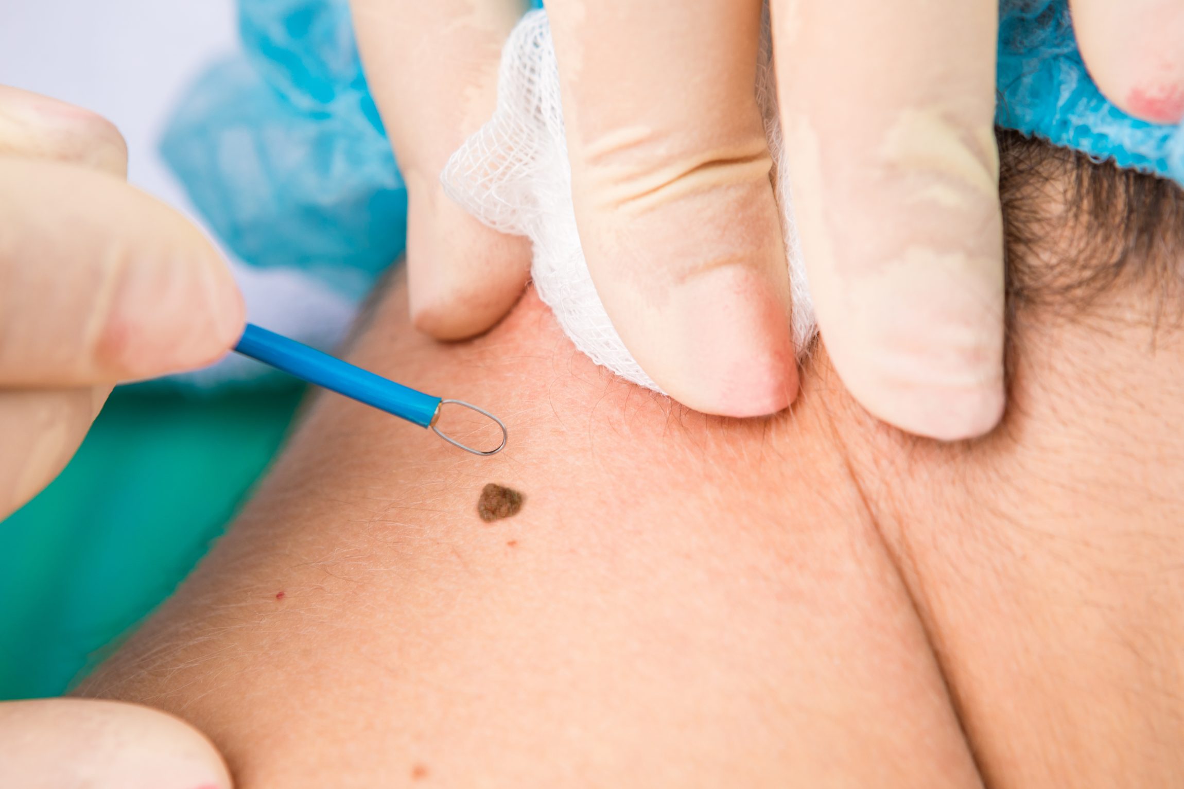 Mole Removal in Abu Dhabi