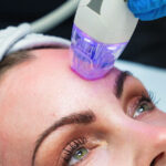 RF Micro Needling Abu Dhabi