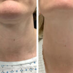 Best Aesthetic Clinic in dubai for RF Microneedling Facial Rejuvenation