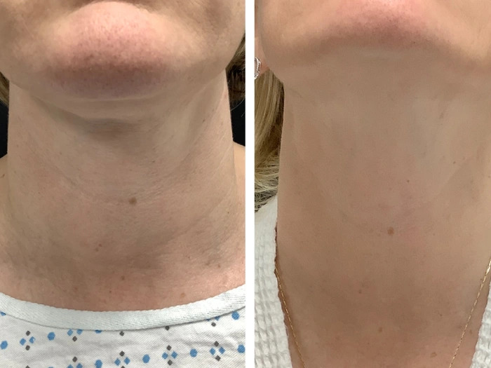 Best Aesthetic Clinic in dubai for RF Microneedling Facial Rejuvenation